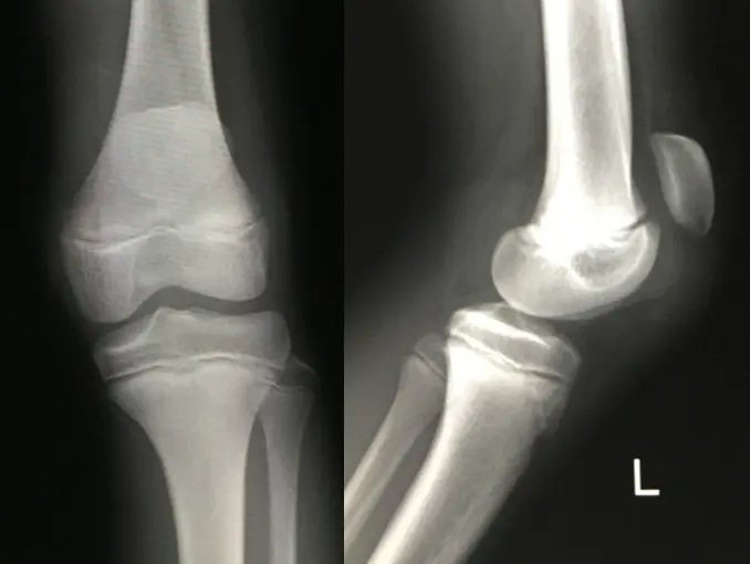 膝蓋骨骨折とは？CT画像診断のポイントは