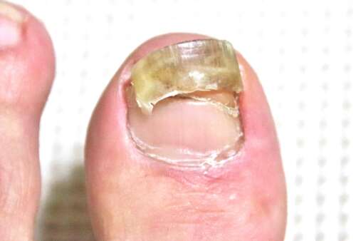 肥厚爪ケア・原因と予防法ドクターネイル爪革命®