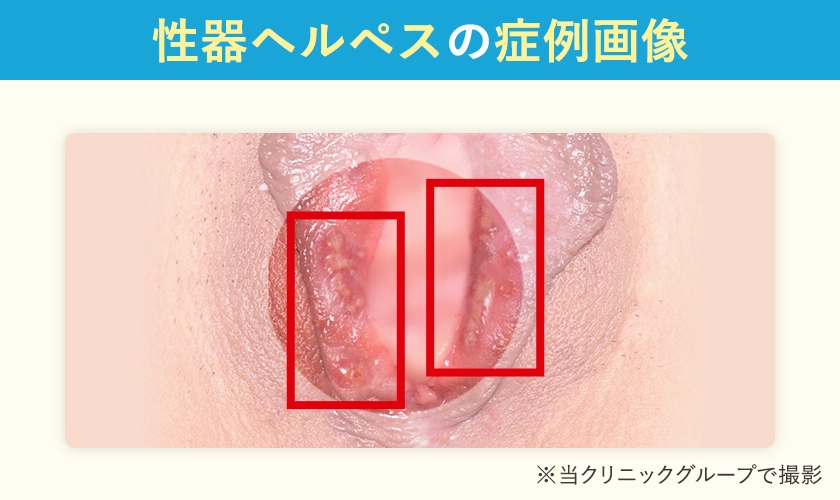 陰部のできもの・しこりの原因と検査、治療薬を解説 画像あり 池袋マイケアヒルズタワークリニック