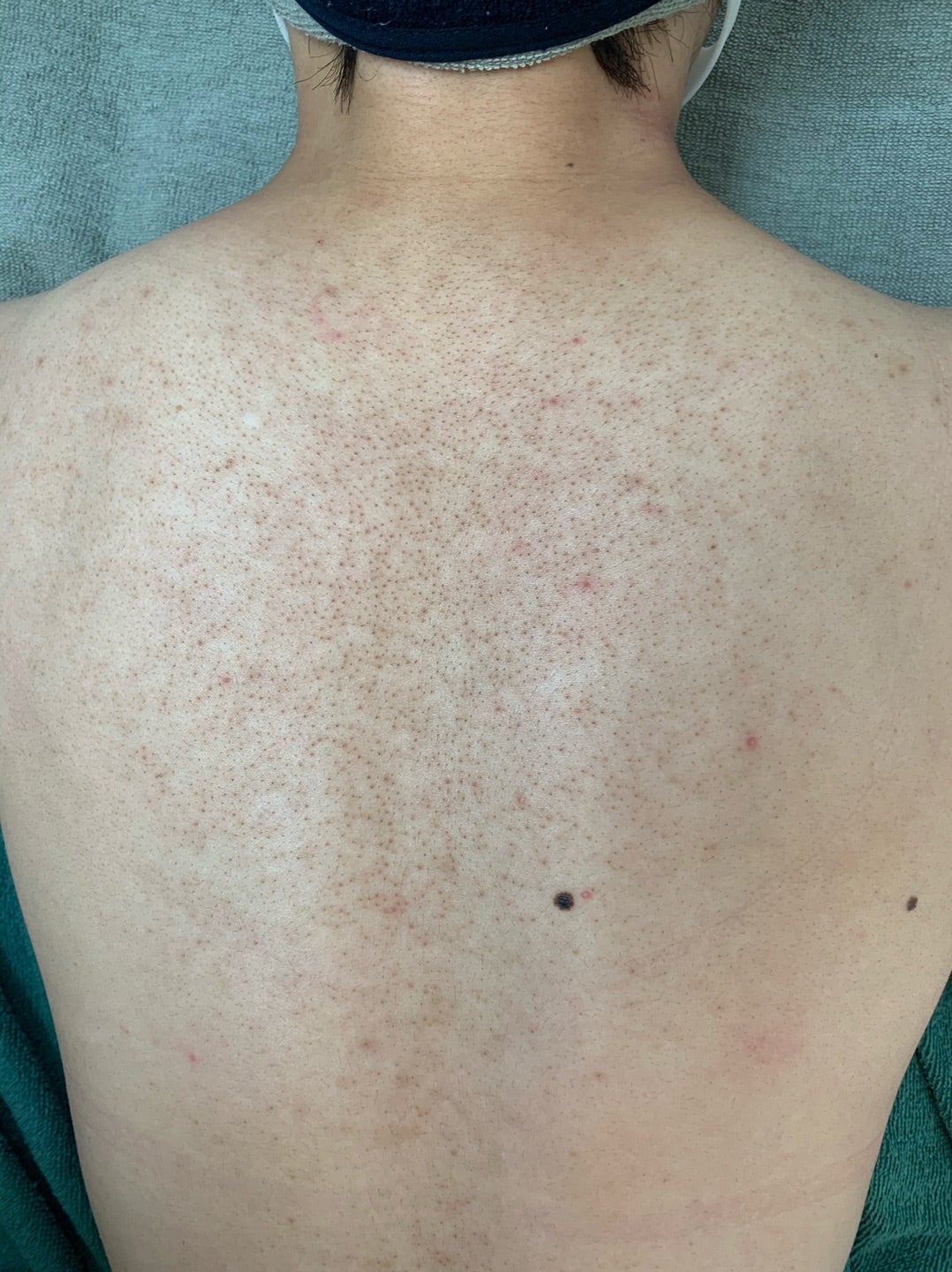 二の腕ブツブツと目立つ毛穴の改善 - サロンドノム神戸ハーブピーリング