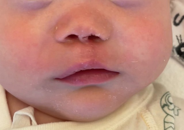 口唇口蓋裂手術 – Leonine