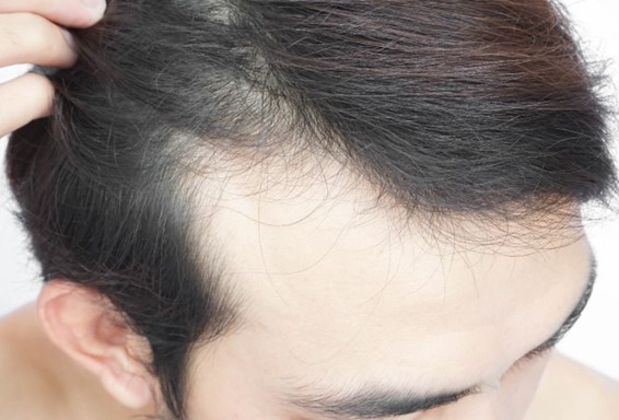 頭皮がピリピリ痛い原因は帯状疱疹？かゆい・痛い時の対策法を解説hagerico スーパースカルプ発毛センター