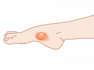 靴擦れかと思ったら水虫だった！皮膚のトラブルは皮膚科で正しい診断を！コレクトサイズ