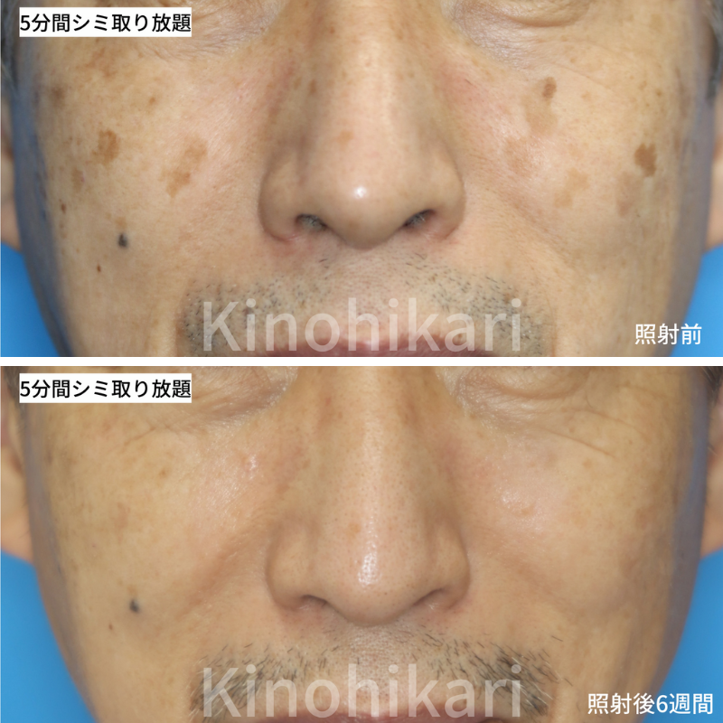 しみの種類と治療法美容整形の 共立美容外科