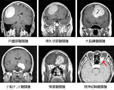髄膜腫対象疾患医療関係者へ近畿大学医学部 脳神経外科