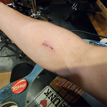 舌や歯茎のしこりに注意！線維腫の特徴と治療法