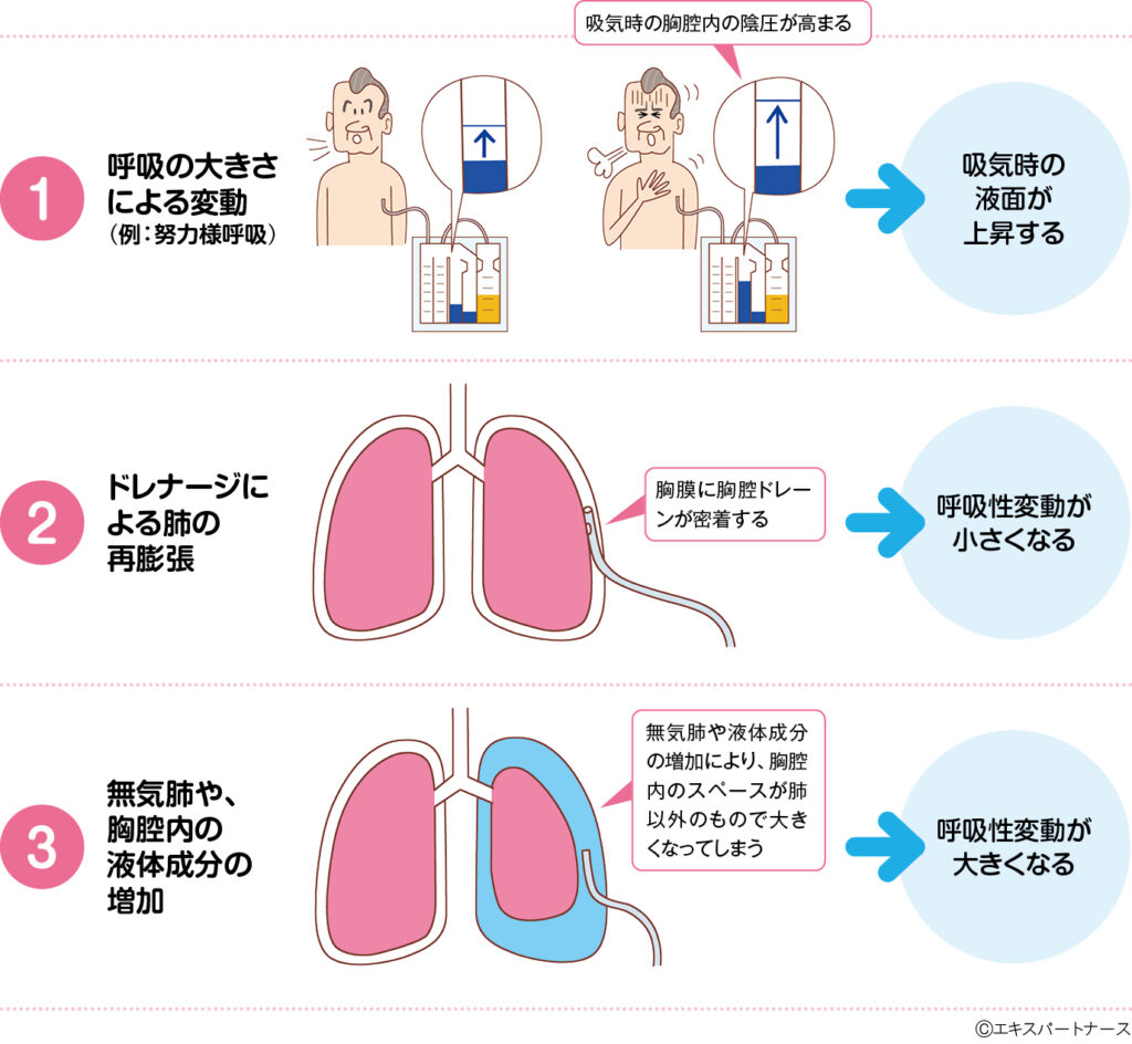 「胸腔ドレナージ」の149点のロイヤリティフリー画像、写真素材、絵Shutterstock