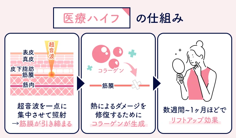 📣 リニアハイフと従来ノハイフの違いを解説 Part.1 プロフィールの公式サイトから お近くのクリニックを検索 ✓※痛みの感じ方や効果には個人差があります※シンデレラハイフハイフハイフ治療ハイフ施術ハイフ効果医療ハイフ美容クリニック美容皮膚科