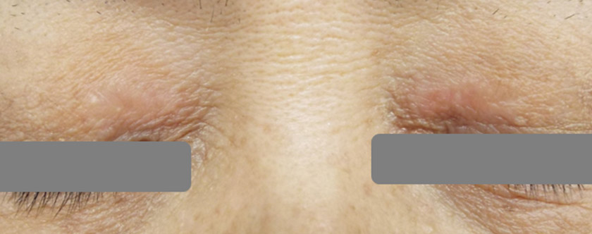 眼瞼黄色腫 がんけんおうしょくしゅ 東京新宿高田馬場の美容皮膚科・皮膚科 保険レーザー治療のみ 「山手皮膚科クリニック」