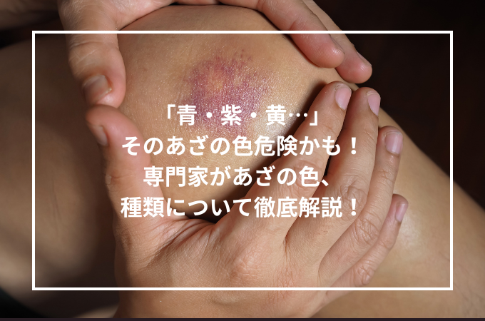 黄あざができる原因は？腕や胸・太ももに身に覚えのないできるあざの対処方法や病気の可能性を解説