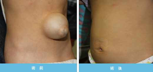 13トリソミー パトウ症候群 胎児のエコーで分かる特徴いつから分かる？東京・ミネルバクリニック