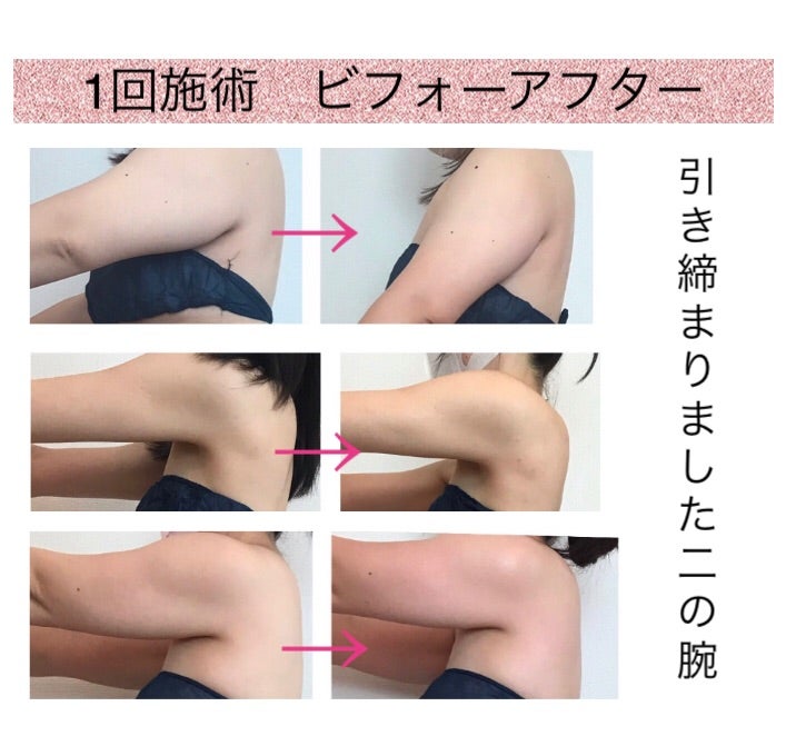 二の腕エステ人気ランキング2023！体験１回でもしっかり痩せると人気なエステを徹底比較SlimMagazine