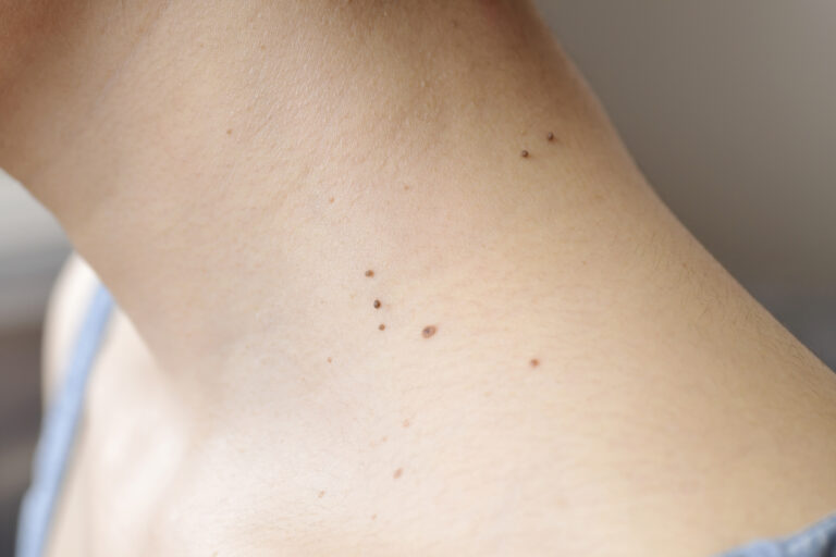 首イボはなぜできる？原因と治療法を医師が解説 - 首イボDr