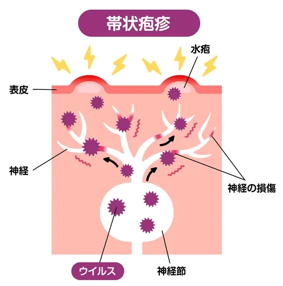 水痘 水ぼうそう ・帯状疱疹 ～感染症～ │ 生活習慣病を予防する 特定非営利活動法人 日本成人病予防協会