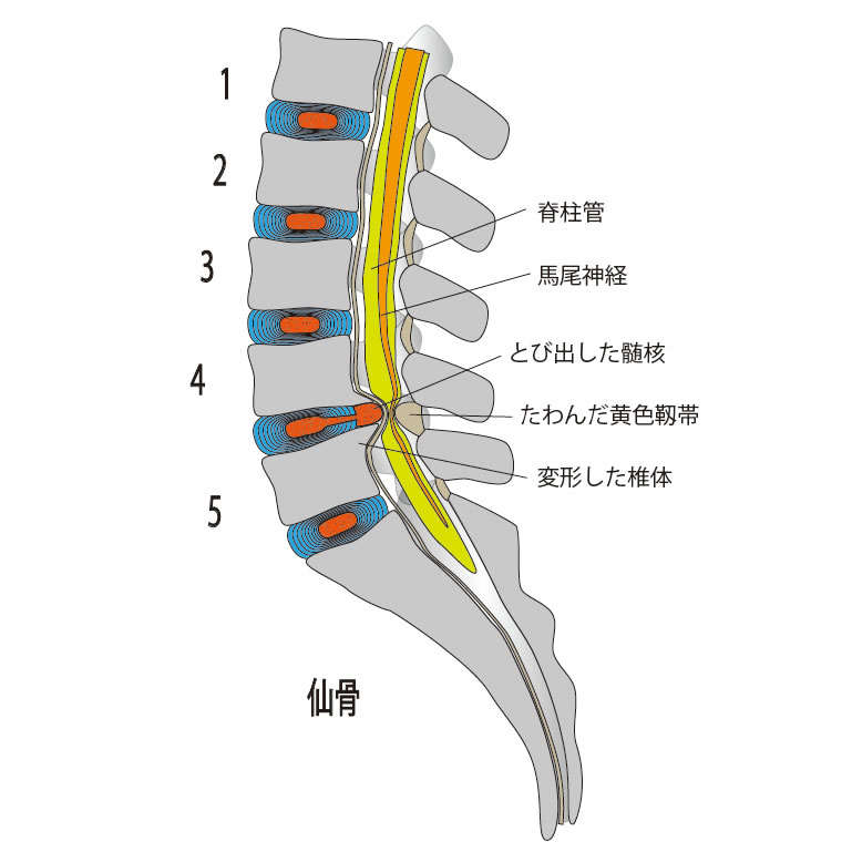 腰椎すべり症とは？脊柱管狭窄症との関連性や効果的な運動・治療法を解説 - はちや整形外科病院