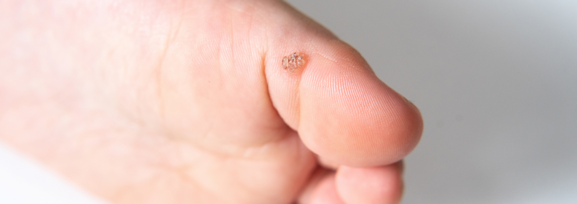 イボ吉祥寺駅徒歩2分の皮膚科 かまだたきこ皮フ科クリニック