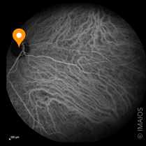 視神経乳頭陥凹拡大の原因と治療水戸市の小沢眼科内科病院