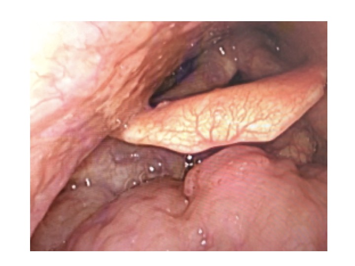 鼻茸とは・鼻ポリープの原因と治療方法大阪の北東大阪耳鼻咽喉科 鼻・副鼻腔手術クリニック