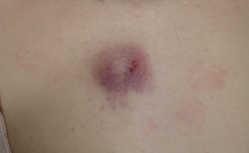 恐怖の粉瘤みんなの美しさのために 行徳形成外科