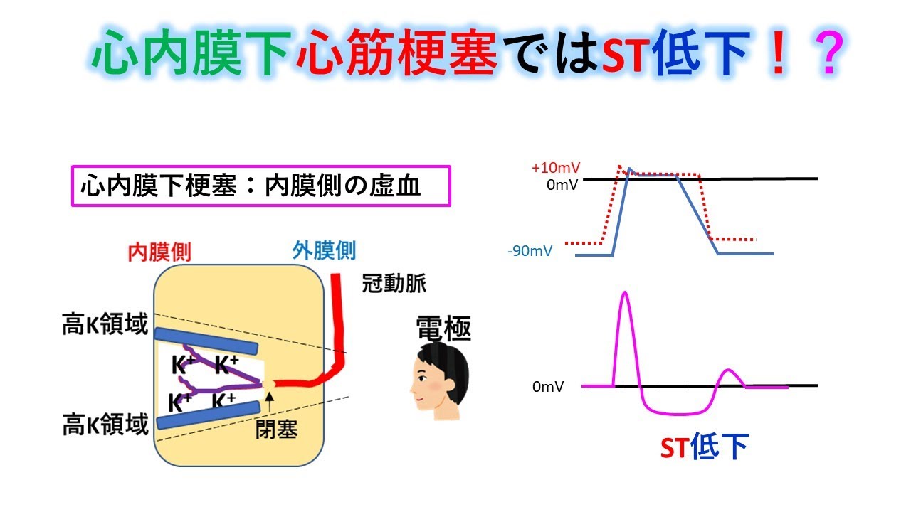 心電図「ST上昇」との戦い│医學事始 いがくことはじめ