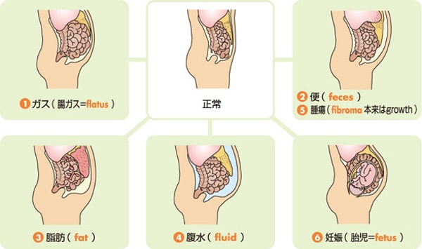 腹部膨満 感 の原因や検査と治療「市販薬or受診」食物繊維は摂っちゃダメ？ - 国立消化器・内視鏡クリニック
