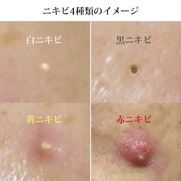 ニキビの種類・症状を知ろう！あなたはどの状態？美容皮膚科タカミクリニック 東京 表参道