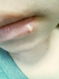 口唇ヘルペスの症状経過