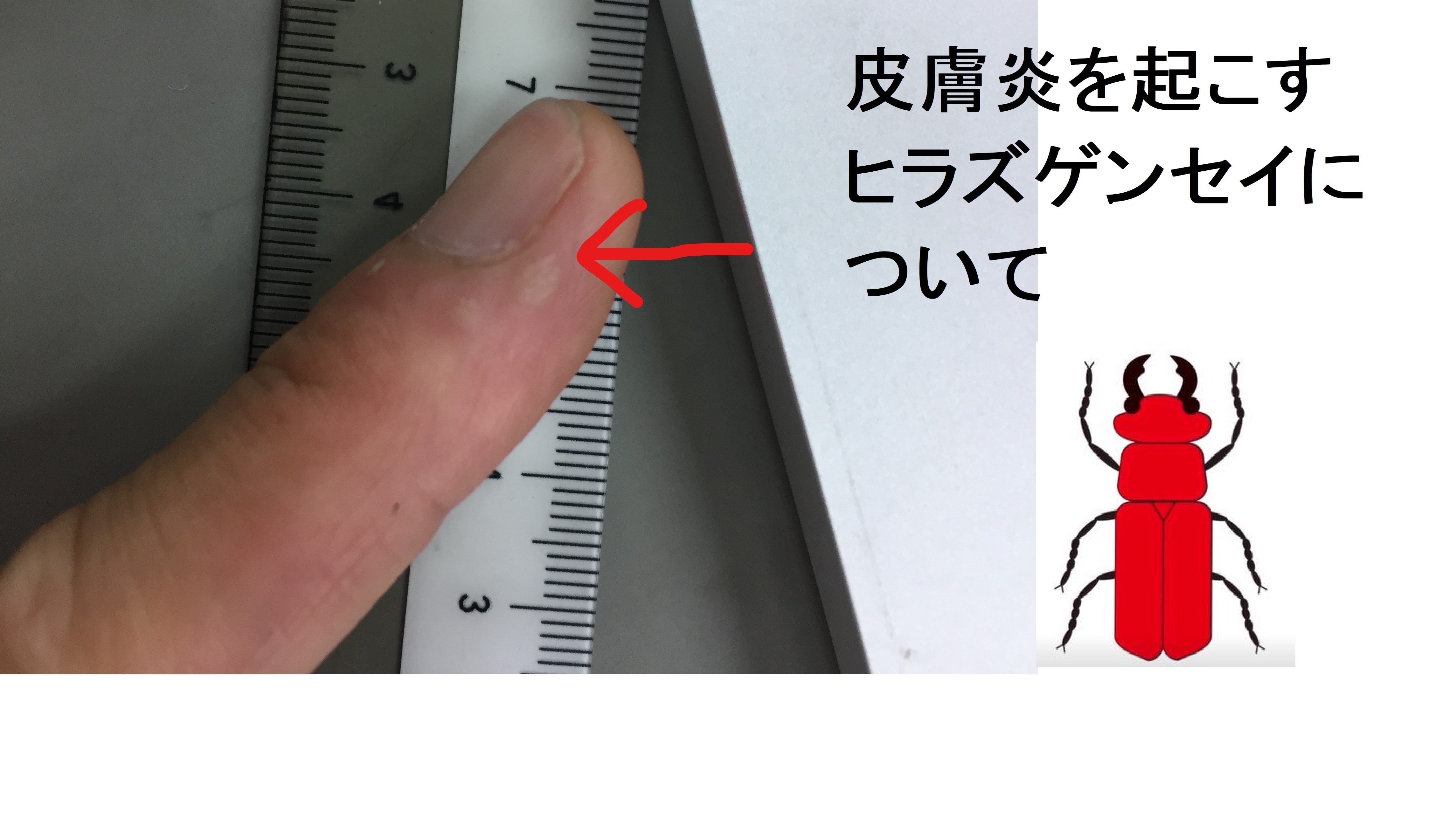 うっかり触らないで！”真っ赤なクワガタ”の姿をもつ謎多き「ヒラズゲンセイ」の生態と応急処置YAMA HACK ヤマハック