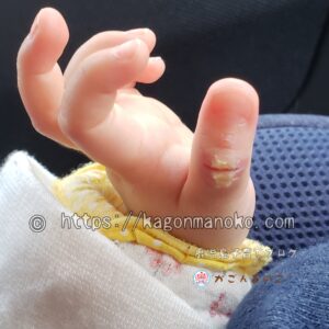 楽天市場 指しゃぶり 防止 手袋 矯正 爪噛み 防止 2歳 吸いだこ 指吸い 予防 方法 やめさせる メッシュ 出っ歯 歯並び 指なめ 対策噛みあわせ 指しゃぶり 選べる2タイプ 3歳 4歳 5歳 調節可能 通気性 送料無料 : Cocolon 楽天市場店