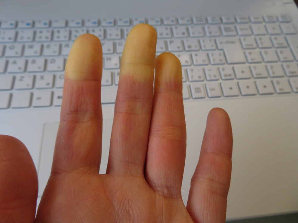 指が白や紫色になる「レイノー病」は何科にいけばいい？Medicalook メディカルック