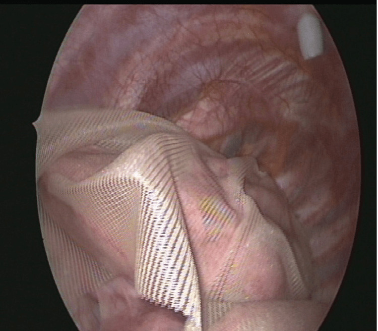 気胸センター 市立札幌病院