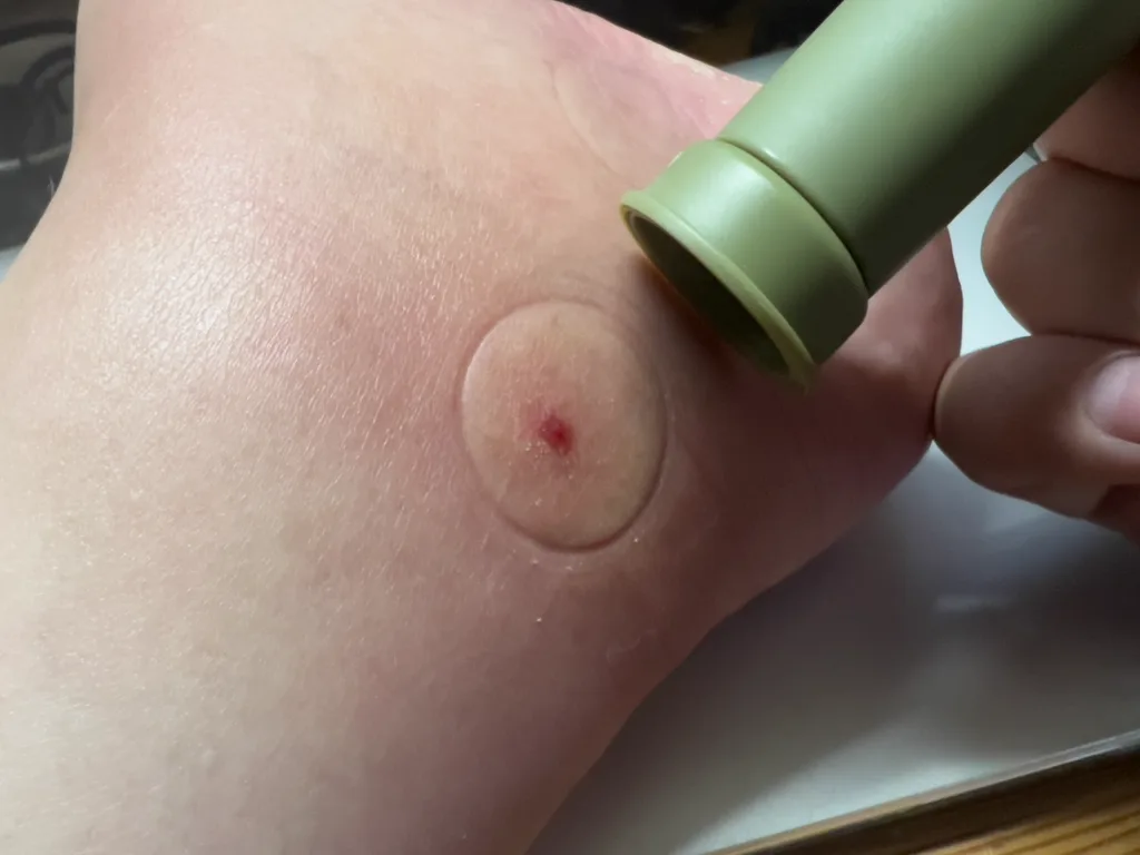 ブヨ・蚊による炎症に効く薬 薬剤師が特徴と選び方を紹介 – EPARKくすりの窓口コラムヘルスケア情報