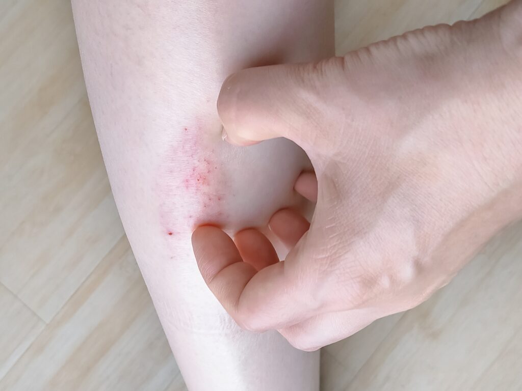 炎症性粉瘤について - 大阪梅田形成外科粉瘤クリニック