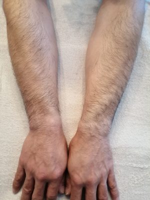 20代 大学生のお客様です。 足。かお、腕脱毛:沖縄那覇市高良にある脱毛メンズサロン Smoothスムース