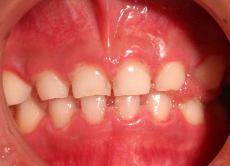 手足口病・ヘルパンギーナの診断と治療┃ヒロクリニック 小児科┃土日祝も18時まで診察┃当日予約もOK