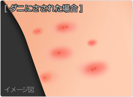 症例画像 虫刺されの症状・対処法 ひどい腫れや痒みも皮膚・爪・髪の病気All About