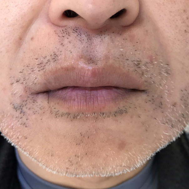 1回目 髭脱毛の効果 写真付き レーザー医療で永久脱毛は可能か？実体験から検証MOTEO