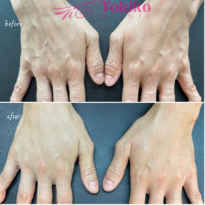 手の甲のシミ治療美容皮膚科 銀座よしえクリニック 公式 東京