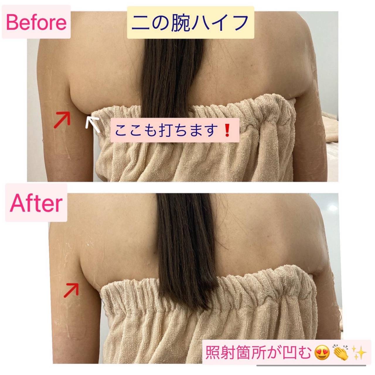 二の腕やせコースコースと料金ダイエットをするならミスパリ ダイエットセンタ