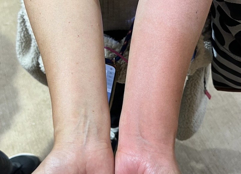 日焼け後の皮むけは無理にはがさないで！早くキレイな肌に戻したいときは、冷却＆保湿の徹底がカギ