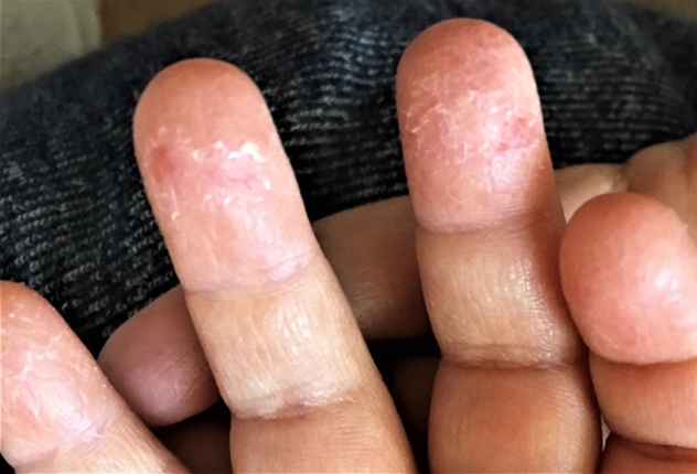 手のひらにほくろがあるんだ。 : r mildlyinteresting