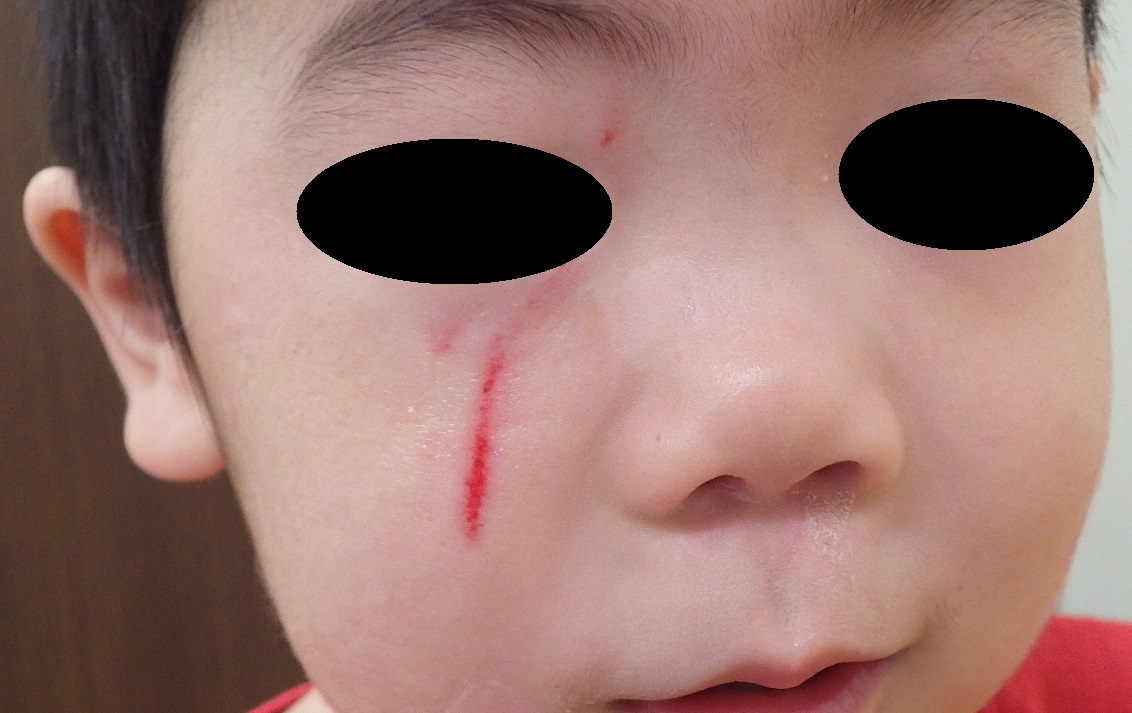 湿潤治療のやりかた - asouiin