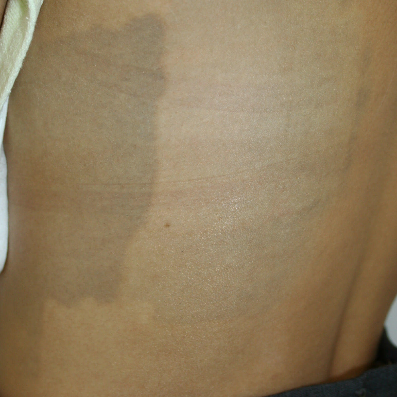 肩の異所性蒙古斑。生後2か月から治療。 - ドクターリコの明日もＨａｐｐｙ