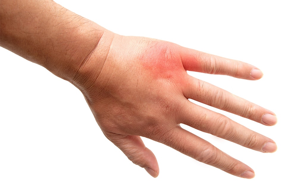 蜂に刺された時の応急処置、その常識は間違いかも。2025年最新の正しい対処法