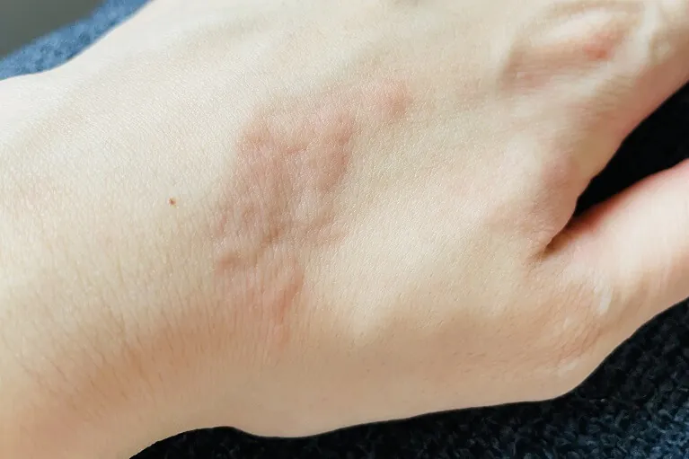 じんましん 蕁麻疹 の原因・種類・治療について、と休日の過ごし方。あゆ皮フ科クリニック高槻市の一般皮膚科・小児皮膚科・皮膚外科・美容皮膚科