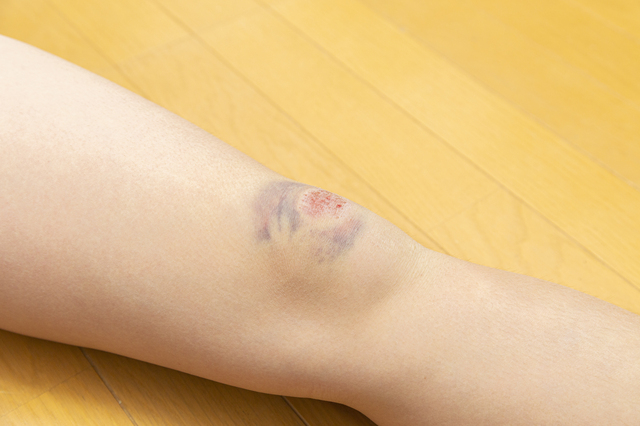 ぶつけていないのに 足に「赤いあざ」ができる病気の原因は？Medicalook メディカルック