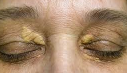 目頭切開 その後 、黒子 ホクロ 、黄色腫横浜市鶴見の形成・美容外科 エムズクリニック