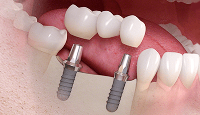 インプラントと天然歯を連結するのは可能ですか？インプラント総合情報サイト「スマイルインプラント」現役歯科医師監修