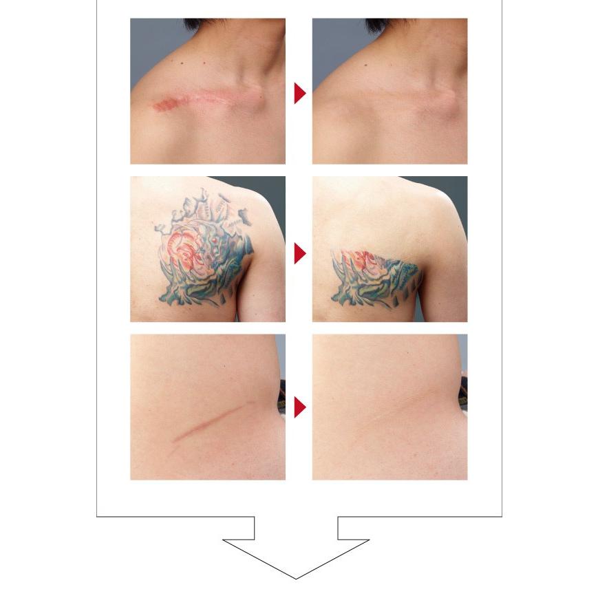 ≪公式≫肌かくしーとオンラインショップ傷あと・あざやタトゥーを隠すスキンカバーシート 肌かくしーと お試しセット 4色入り