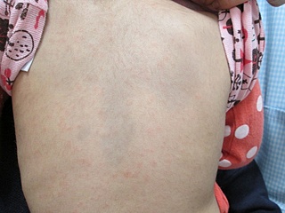 突発性発疹症つだ小児科クリニック世田谷区 小児科一般・アレルギー科・乳幼児健診・予防接種